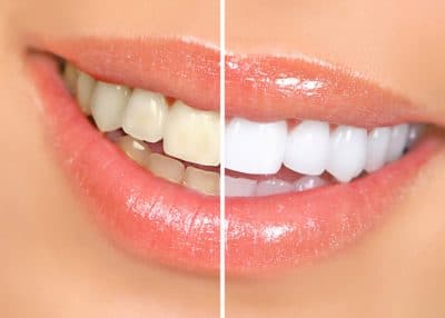 blanqueamiento dental sonrisa radiante